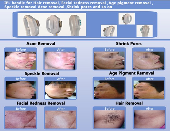 Verticle E-light IPL RF, Yag Hair Removal / Tattoo Removal Beauty Beauty