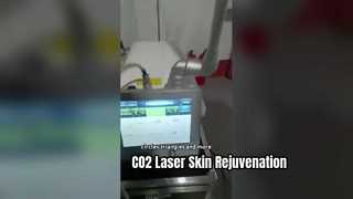 30W RF Tube Fractional CO2 laser để loại bỏ sẹo