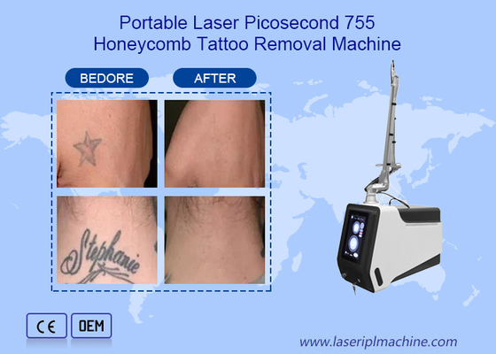 Thiết bị xóa hình xăm bằng laser Nd Yag Picosecond 755nm 1064nm 532nm