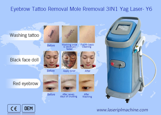 1064nm 532nm Nd Yag Máy loại bỏ hình xăm bằng laser